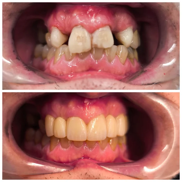 Comparativa frontal de ambas arcadas, caso clínico 2 · Clínica Dental Divina Pastora, Ansoáin