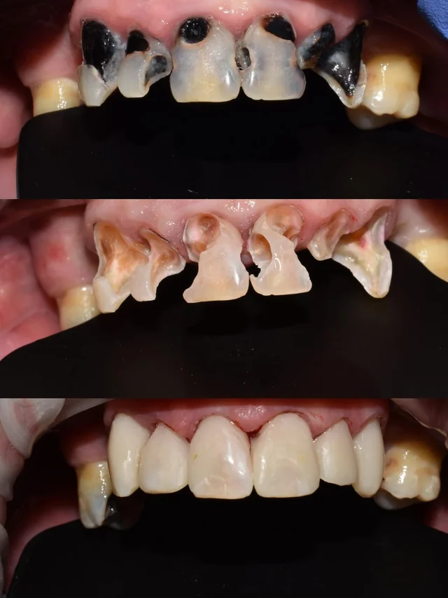Secuencia clínica de dientes anteriores, caso clínico 3 · Clínica Dental Divina Pastora, Ansoáin