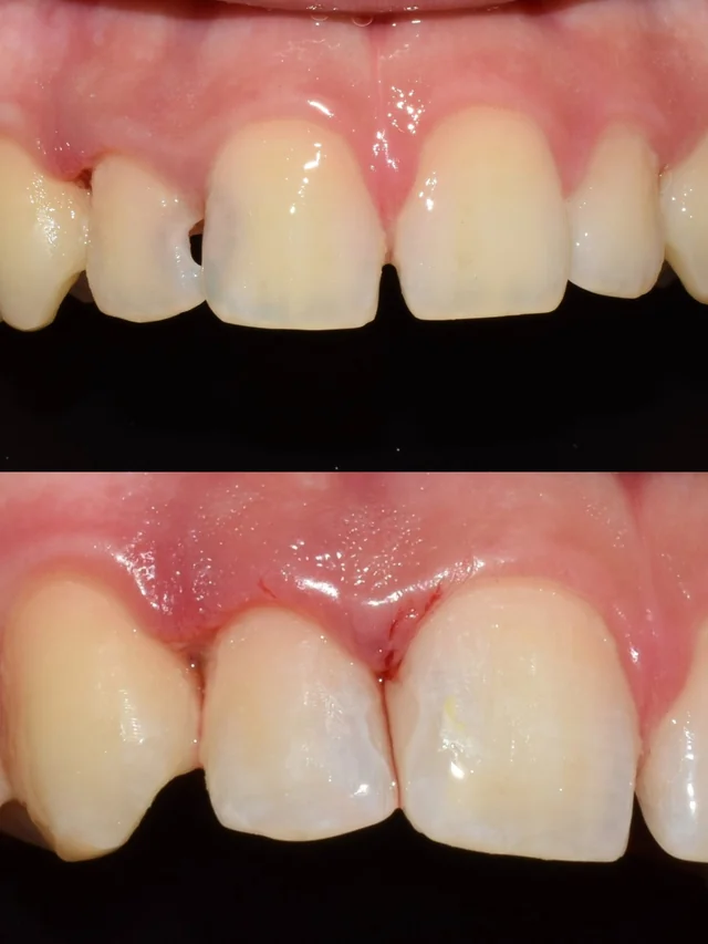 Comparativa frontal de incisivos, caso clínico 5 · Clínica Dental Divina Pastora, Ansoáin