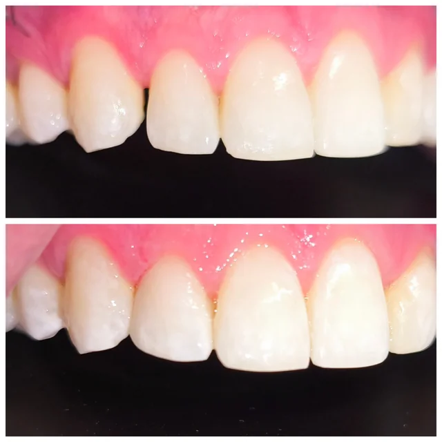 Cierre de diastema, comparativa de dientes anteriores · Clínica Dental Divina Pastora, Ansoáin