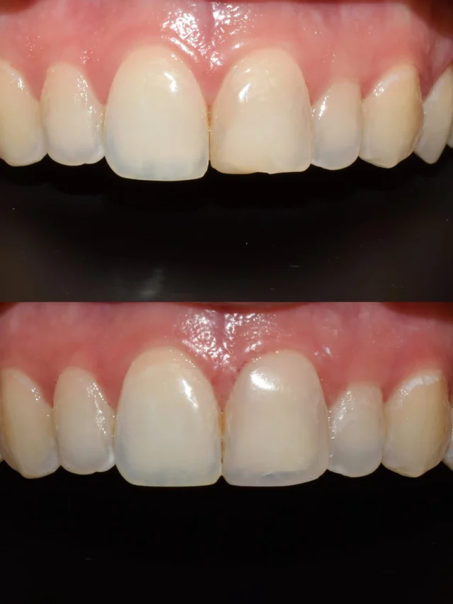 Caso ICON 1, comparativa de dientes anteriores · Clínica Dental Divina Pastora, Ansoáin