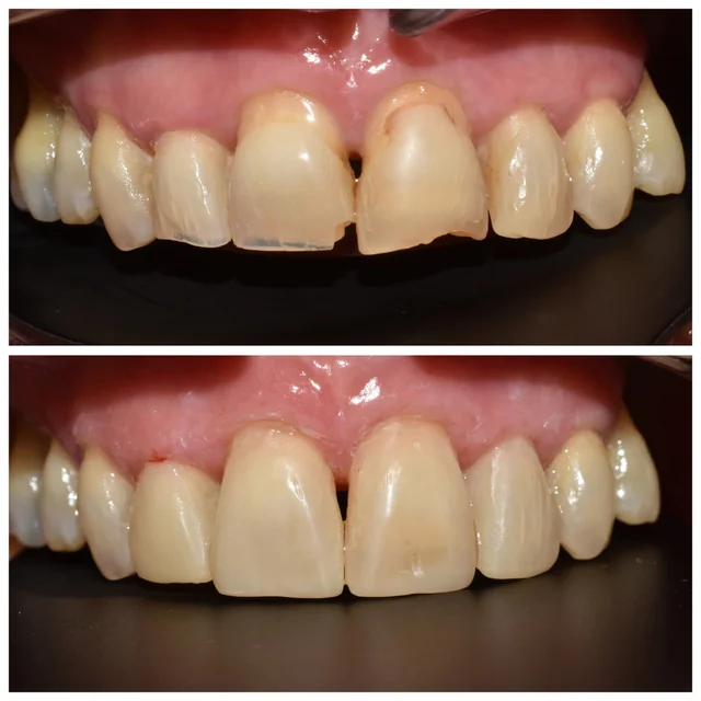 Caso ICON 2, registro fotográfico de dientes anteriores · Clínica Dental Divina Pastora, Ansoáin