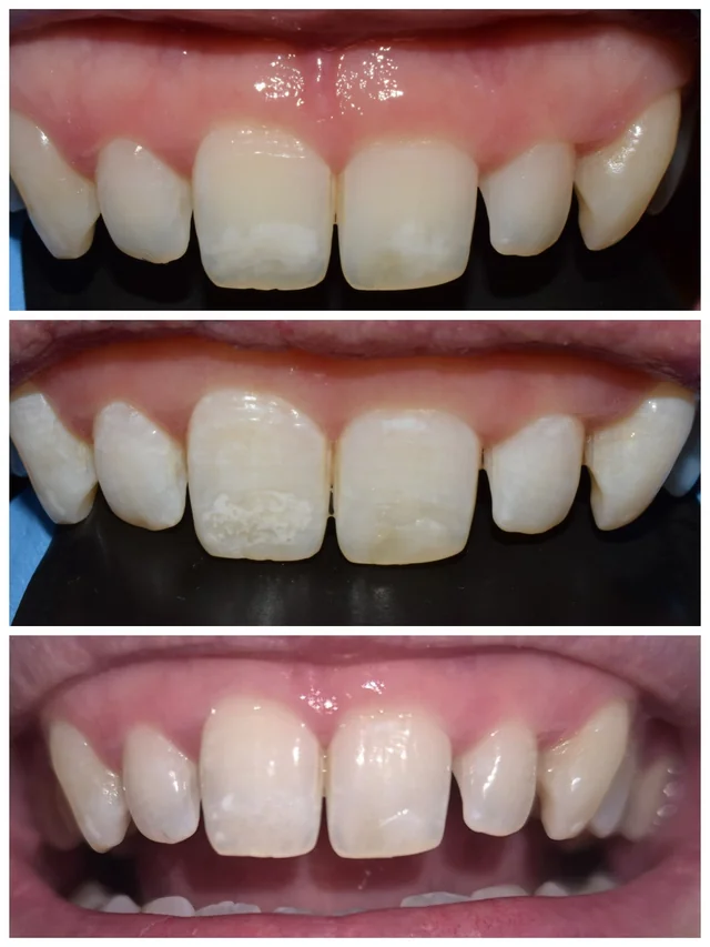 Caso ICON 3, secuencia de tres fotografías de dientes anteriores · Clínica Dental Divina Pastora, Ansoáin