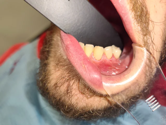 Segunda fotografía del mismo caso dental, vista lateral · Clínica Dental Divina Pastora, Ansoáin